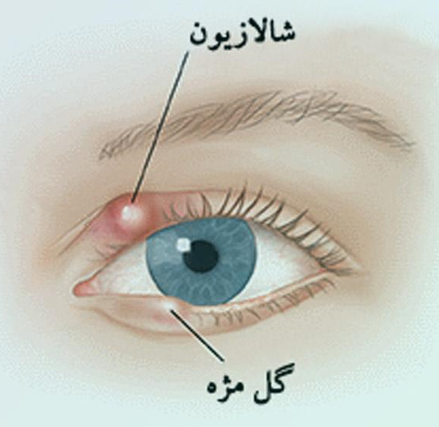 بیماری شالازیون چشم