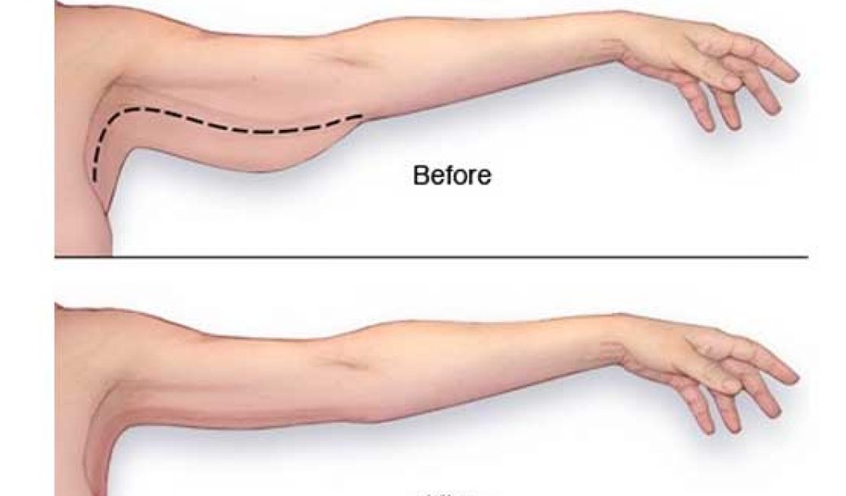 آیا لیفت بازو بدون جراحی امکان پذیر است