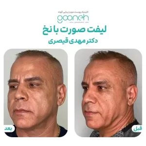 قیمت لیفت صورت با نخ