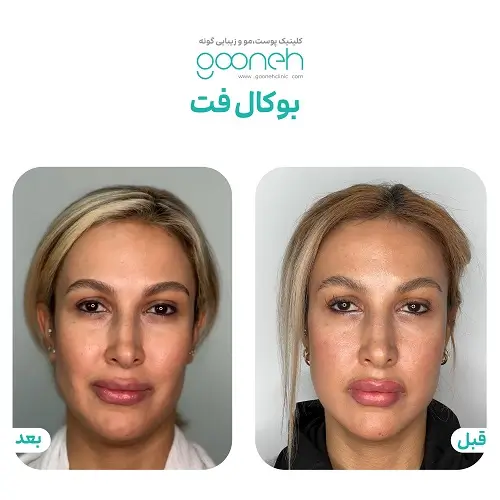 بوکال فت و افتادگی پوست