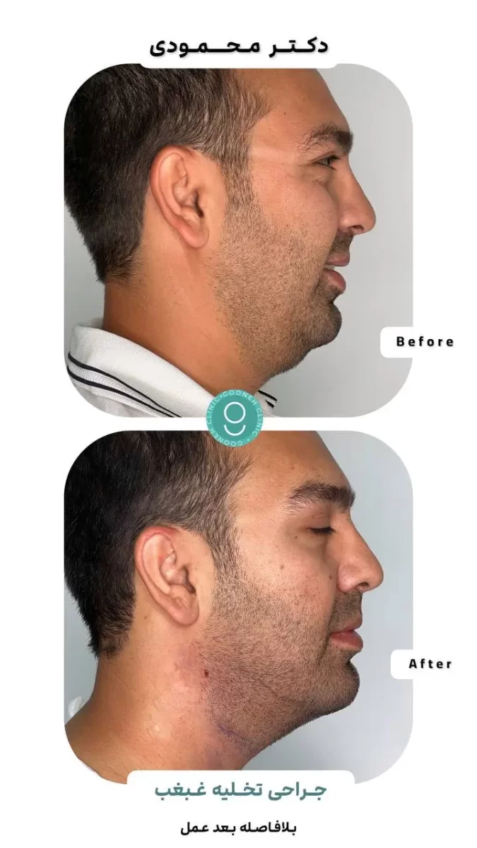 ایا بوکال فت باعث افتادگی پوست میشود