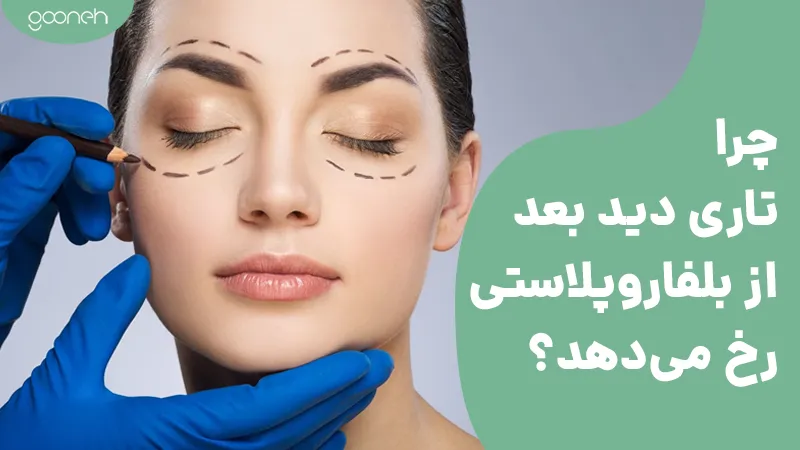 چرا تاری دید بعد از بلفاروپلاستی رخ می‌دهد؟ (علت + راه‌های درمان و پیشگیری)
