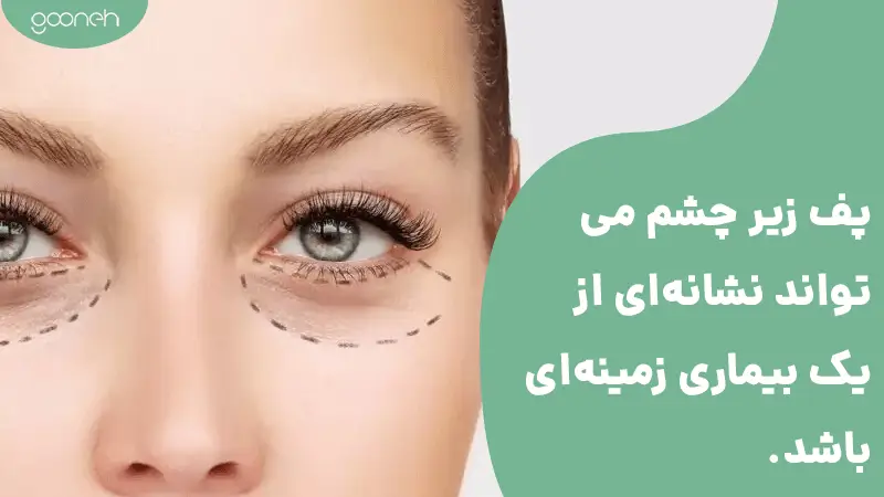 پف زیرچشم ناشی از بیماری زمینه ای