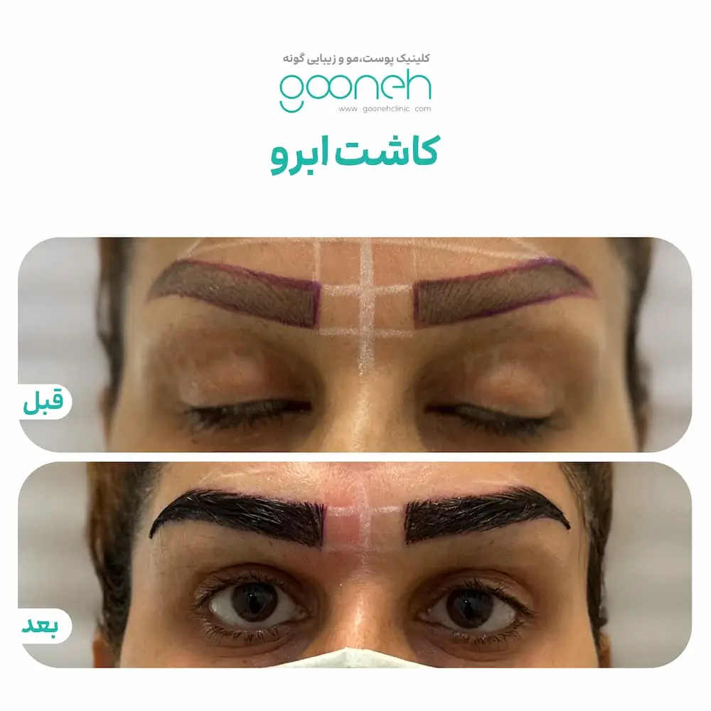 نمونه کار کاشت ابرو