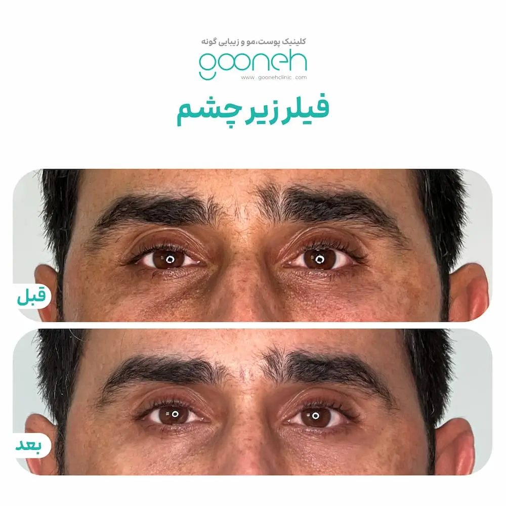 نمونه تزریق فیلر زیر چشم