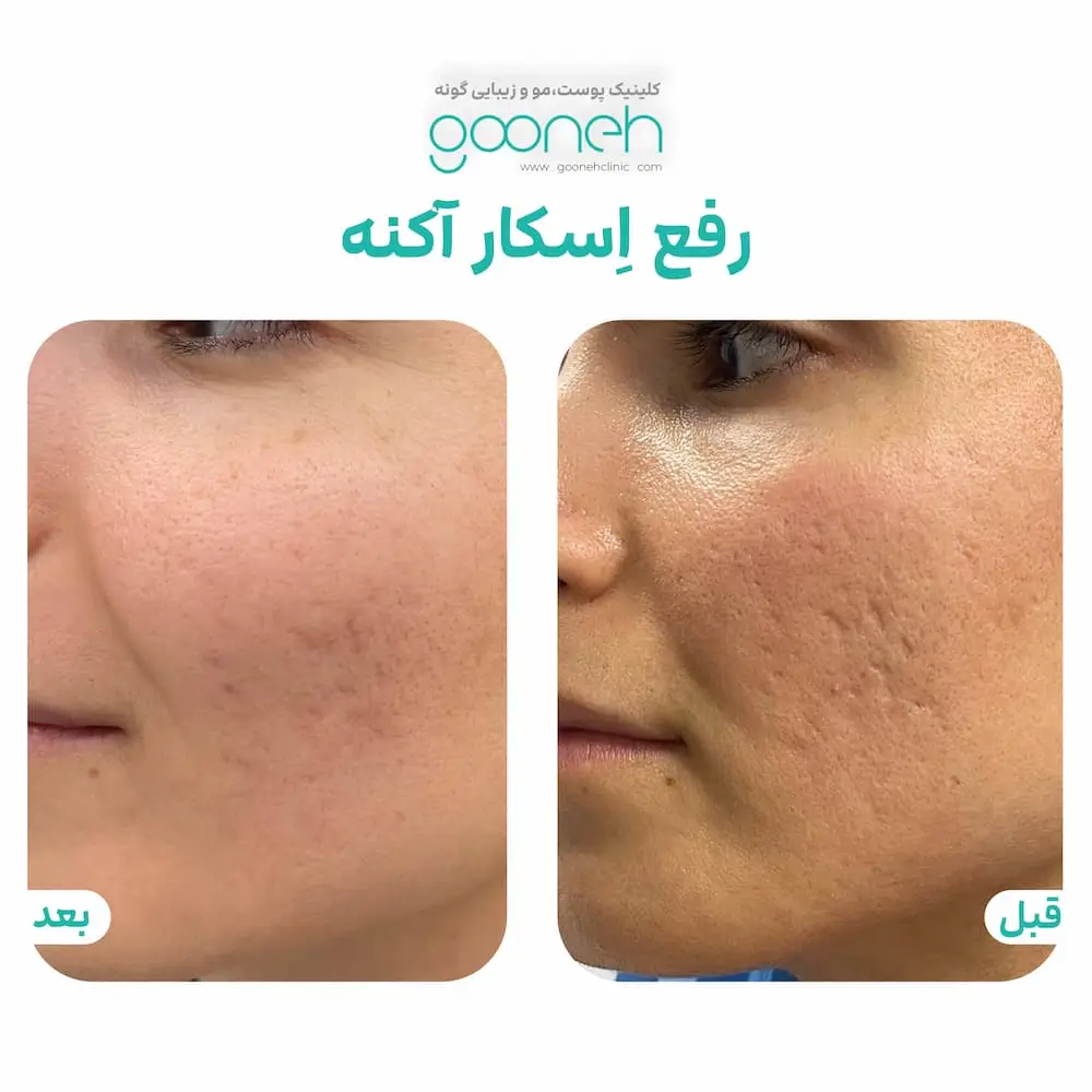 رفع اسکار آکنه