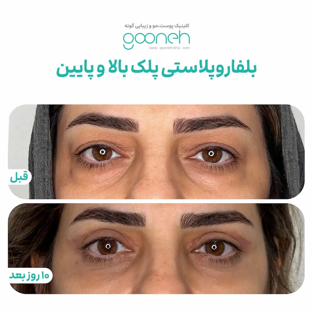 نمونه کار بلفاروپلاستی