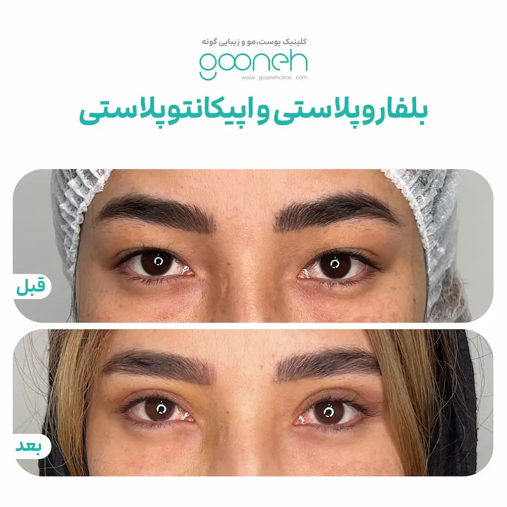 نمونه جراحی پلک