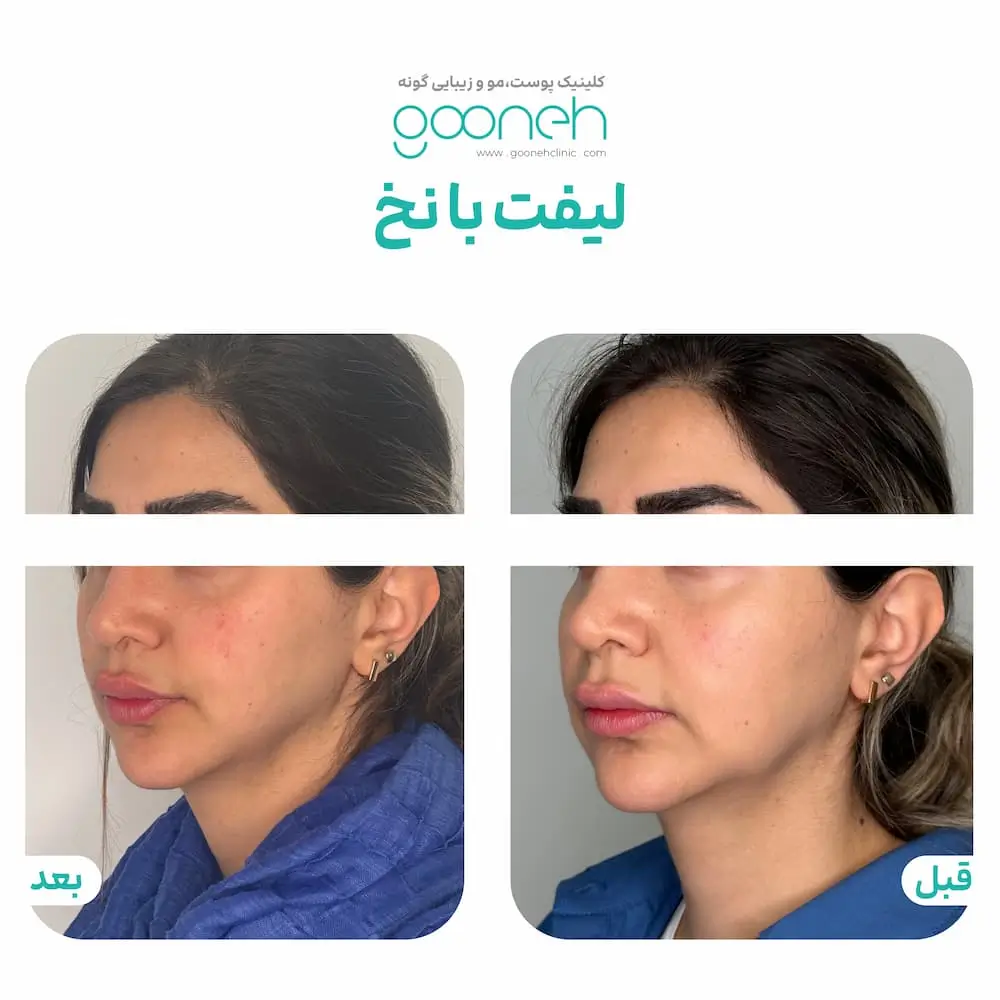 عکس قبل و بعد لیفت صورت با نخ