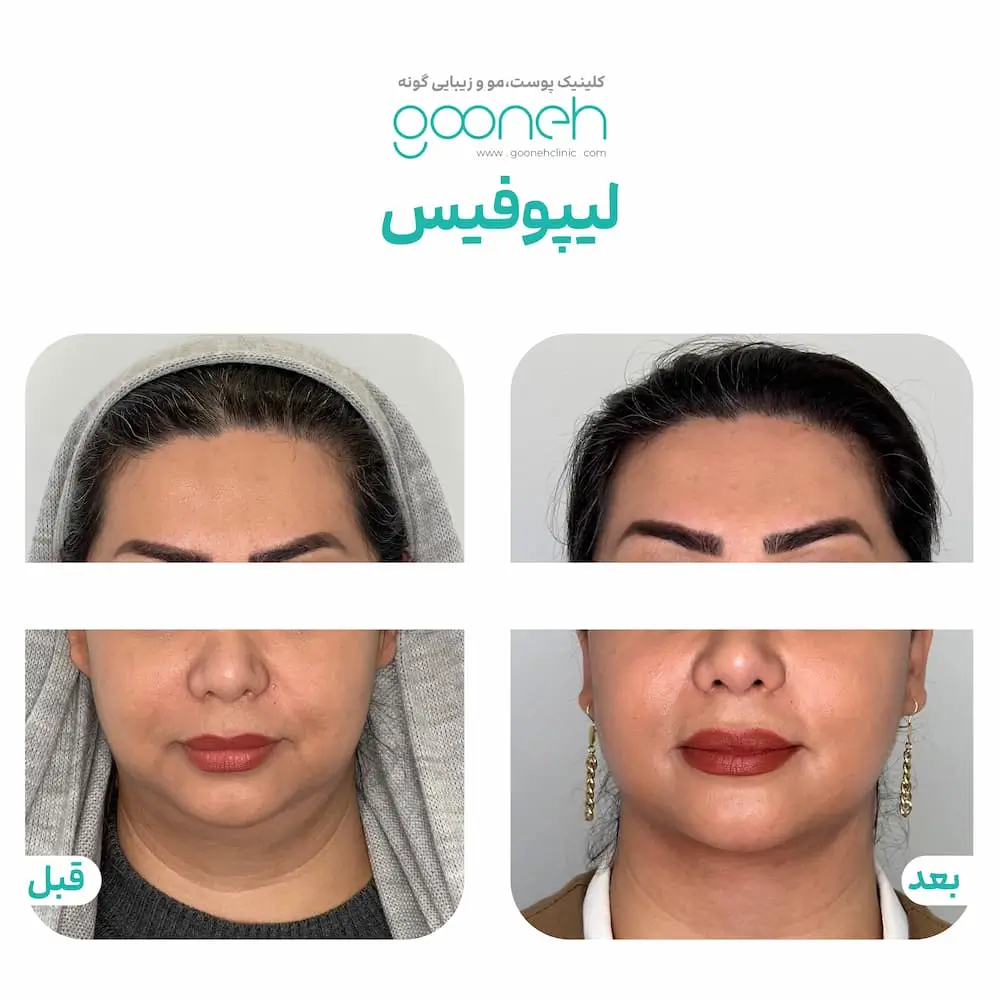عمل بوکال فت و غبغب