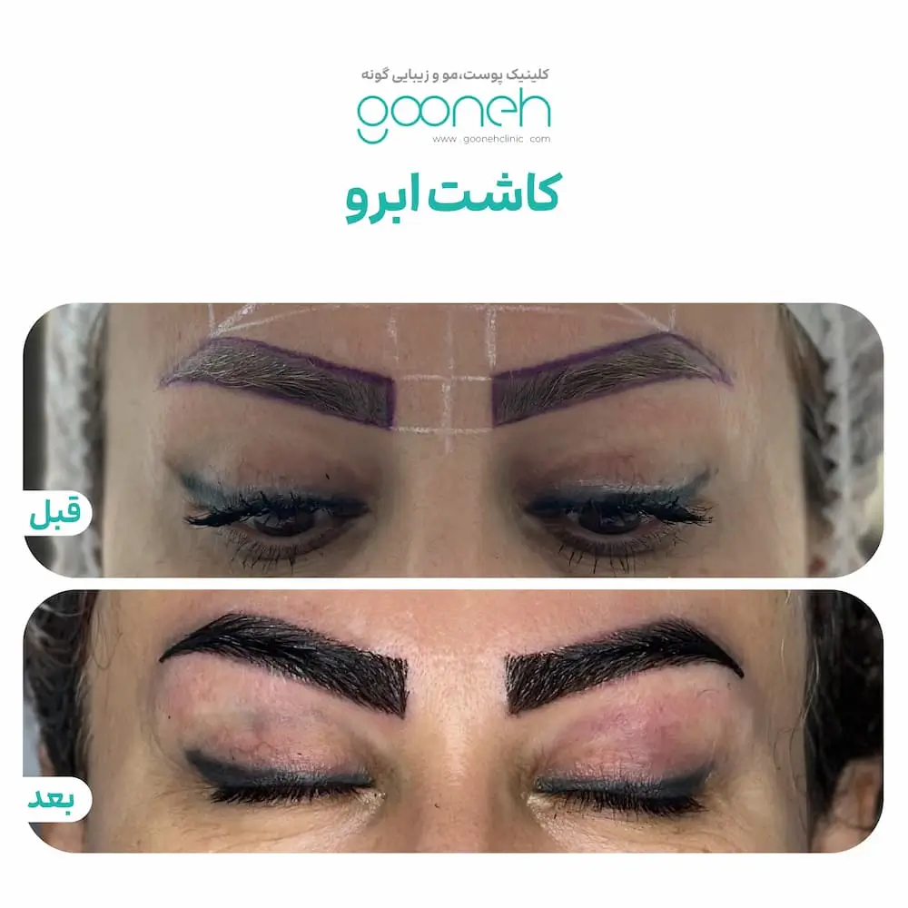 نمونه کار کاشت ابرو