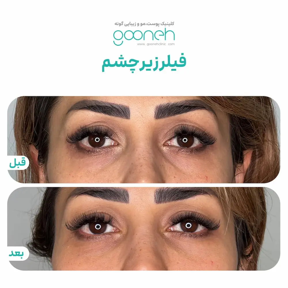 نمونه کار فیلر زیر چشم