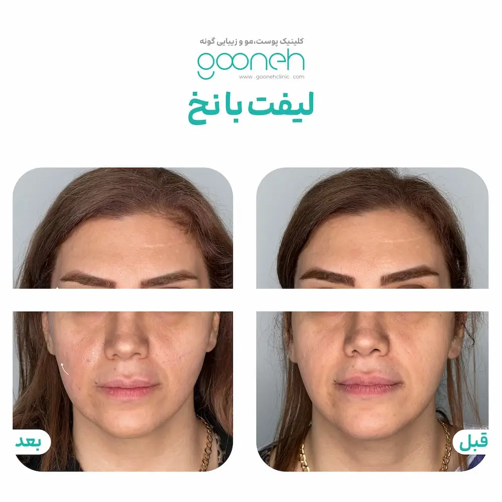 عکس قبل و بعد لیفت صورت