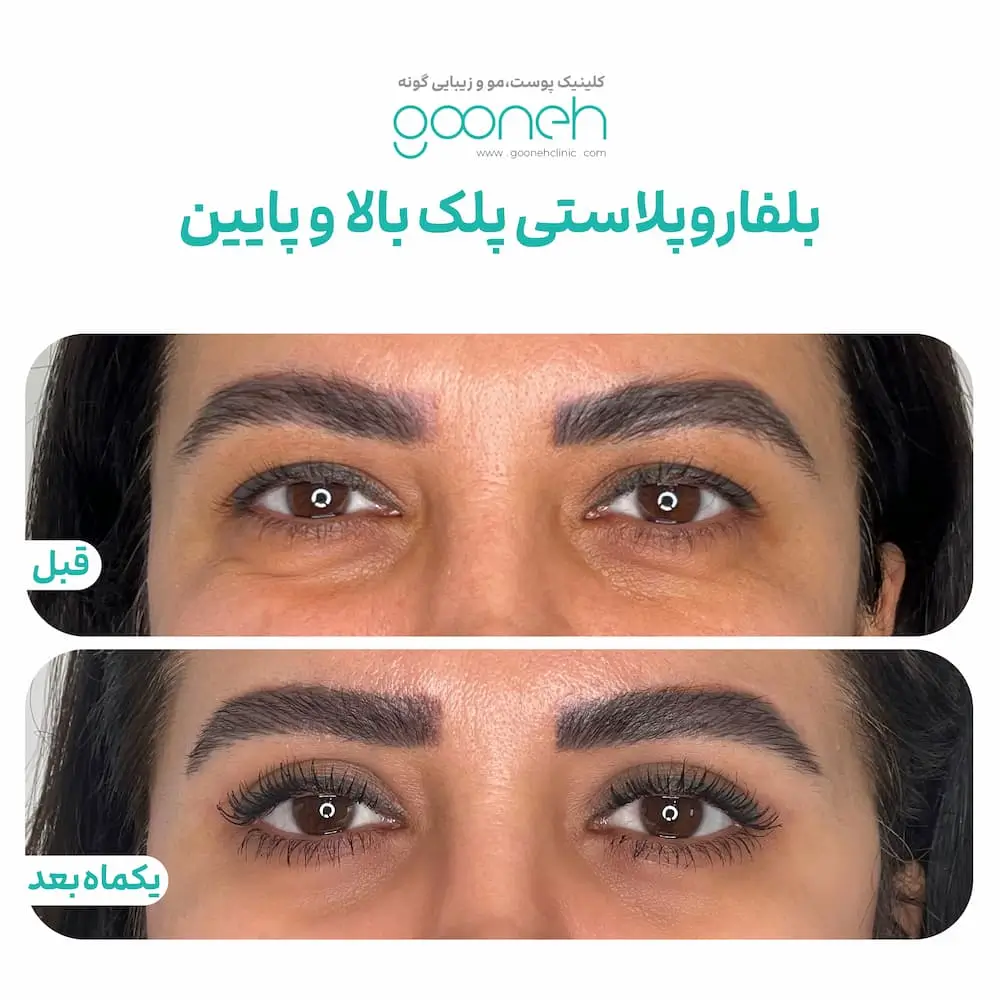 نمونه کار بلفاروپلاستی