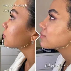 تزریق فیلر به چانه