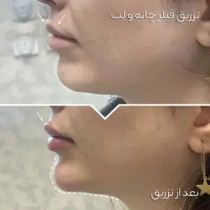 فیلر چانه