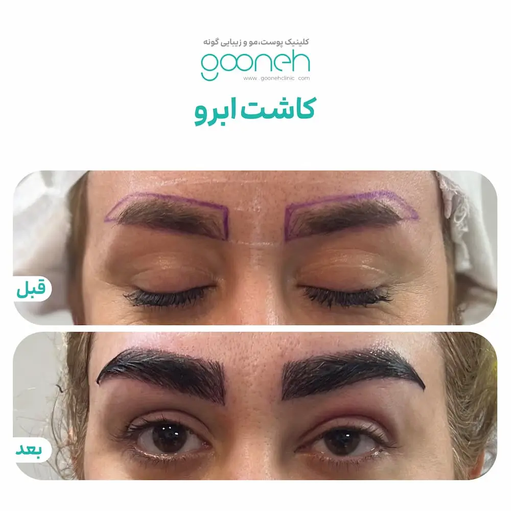 قبل و بعد کاشت ابرو