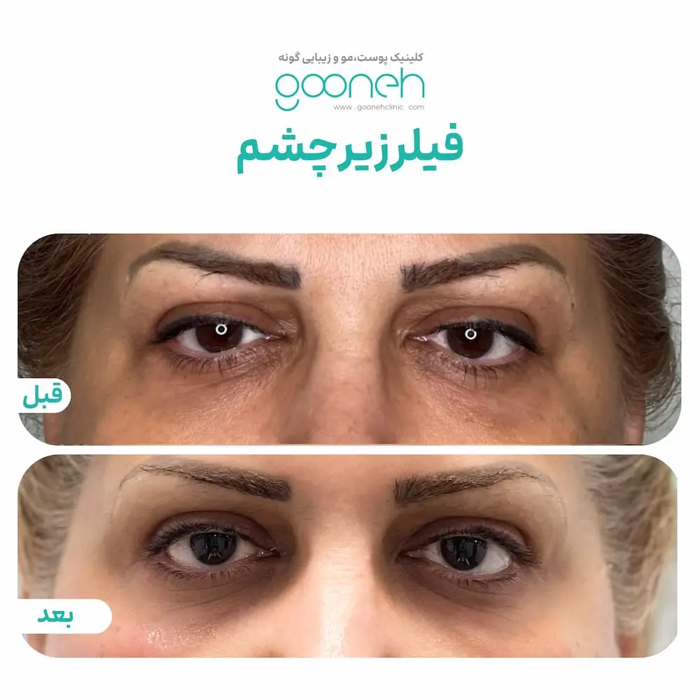 نتایج نهایی فیلر زیر چشم