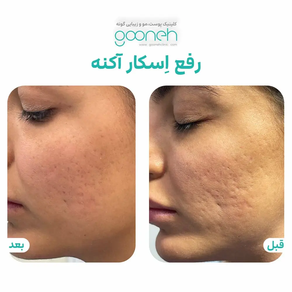 رفع جای جوش