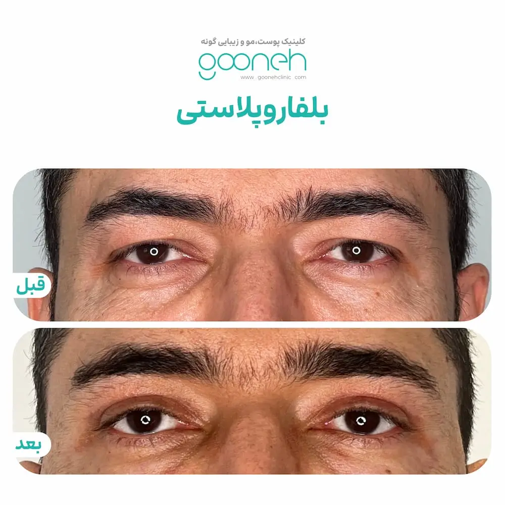 نمونه کار بلفاروپلاستی