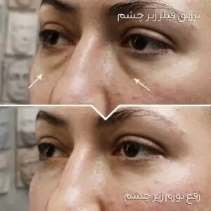 تاثیر فیلر زیر چشم