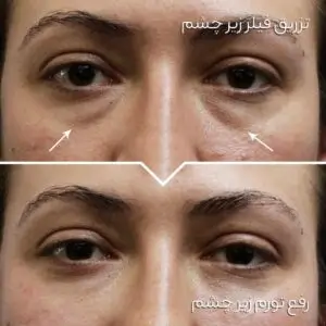 نحوه تزریق فیلر زیر چشم