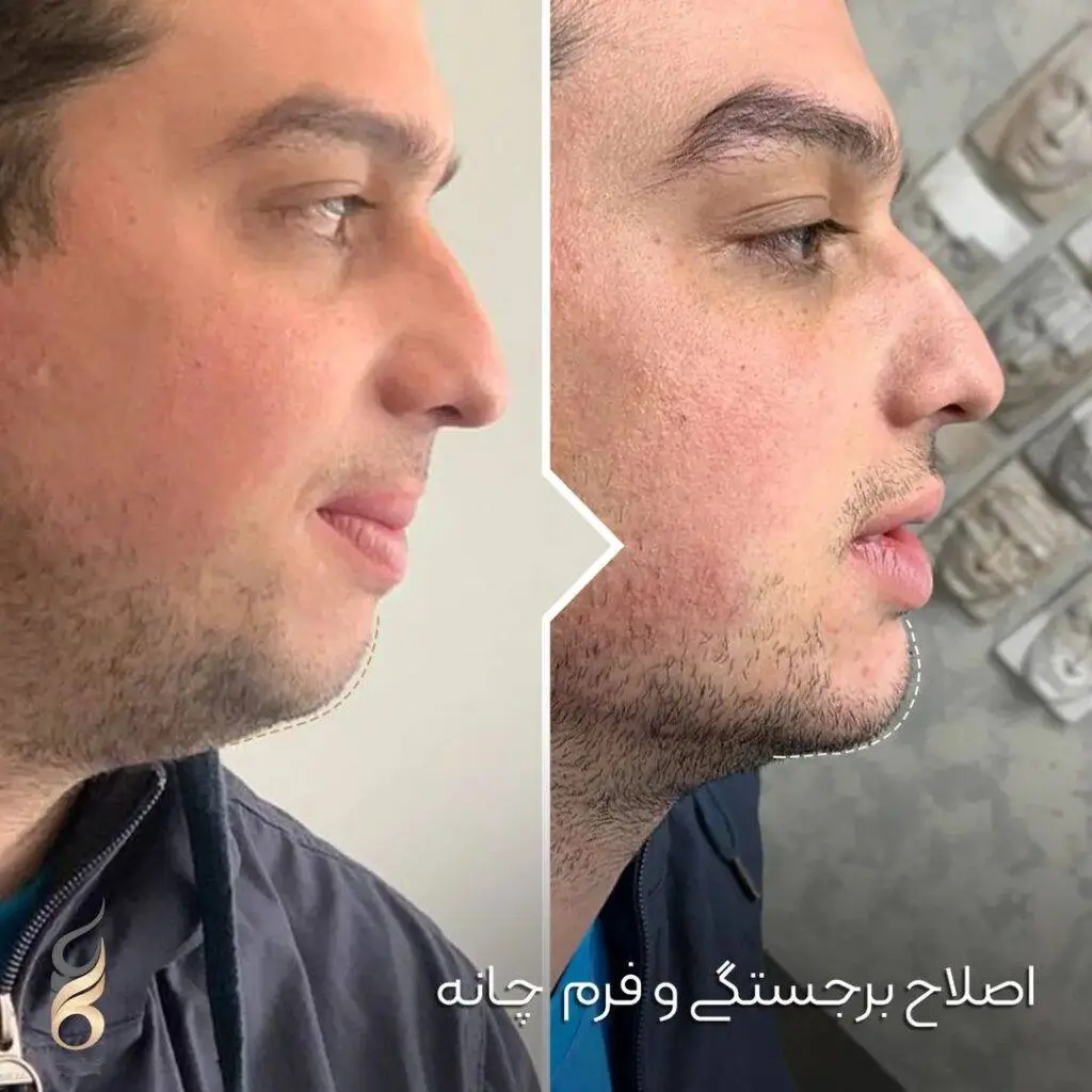 فیلر چانه چیست