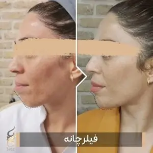 فیلر چانه
