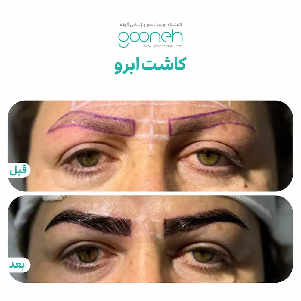 قبل و بعد کاشت ابرو