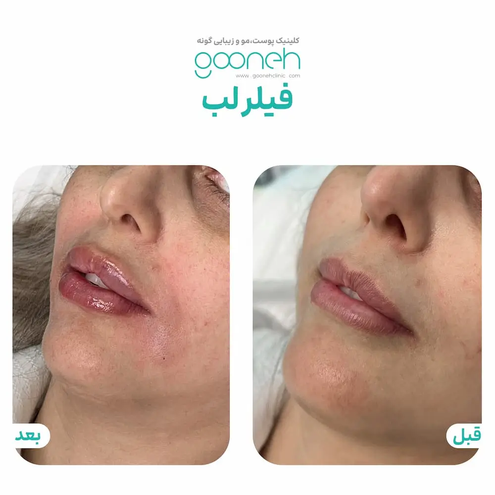 عکس تزریق لب