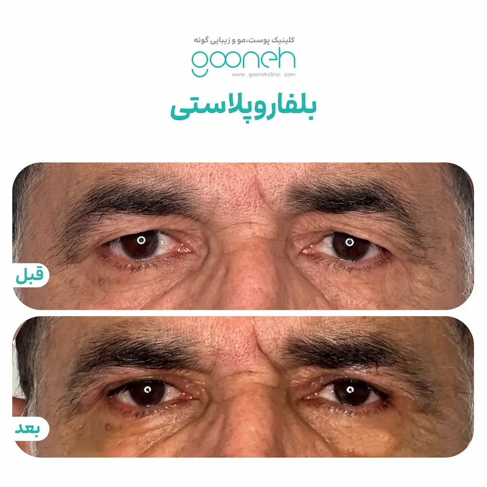 نمونه جراحی پلک