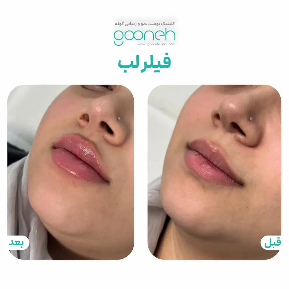 عکس تزریق لب
