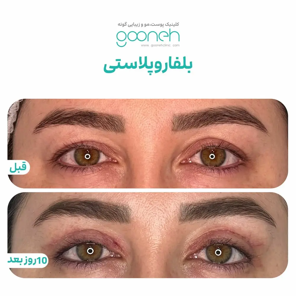 نمونه جراحی پلک