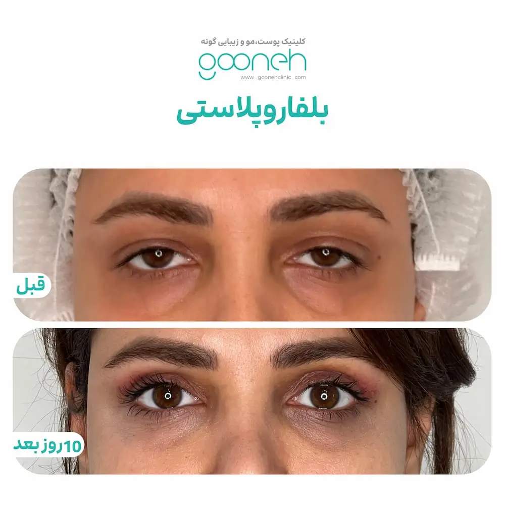 نمونه جراحی پلک