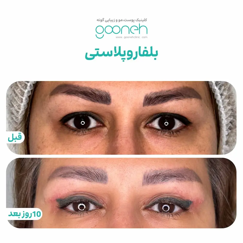 نمونه جراحی پلک