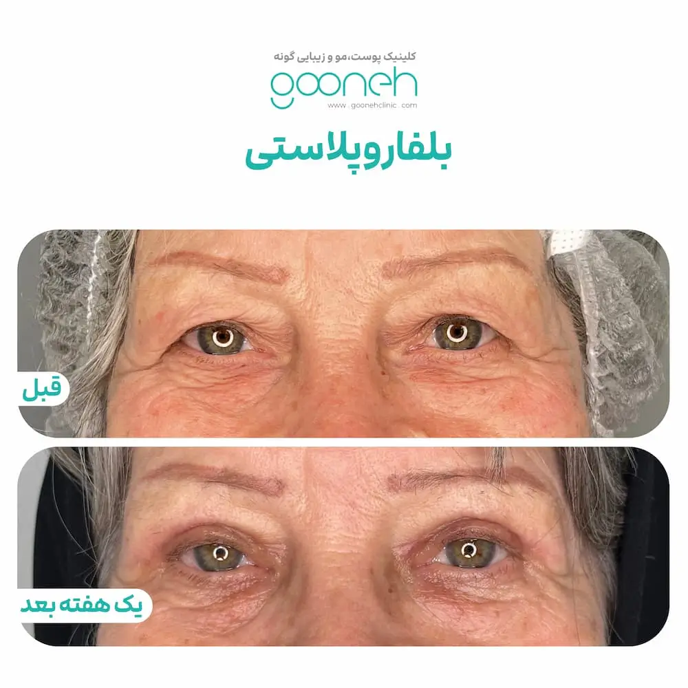نمونه جراحی پلک