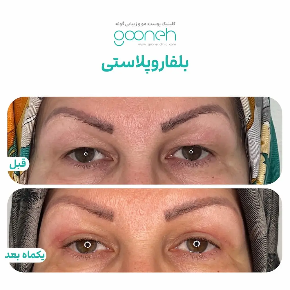 نمونه جراحی پلک