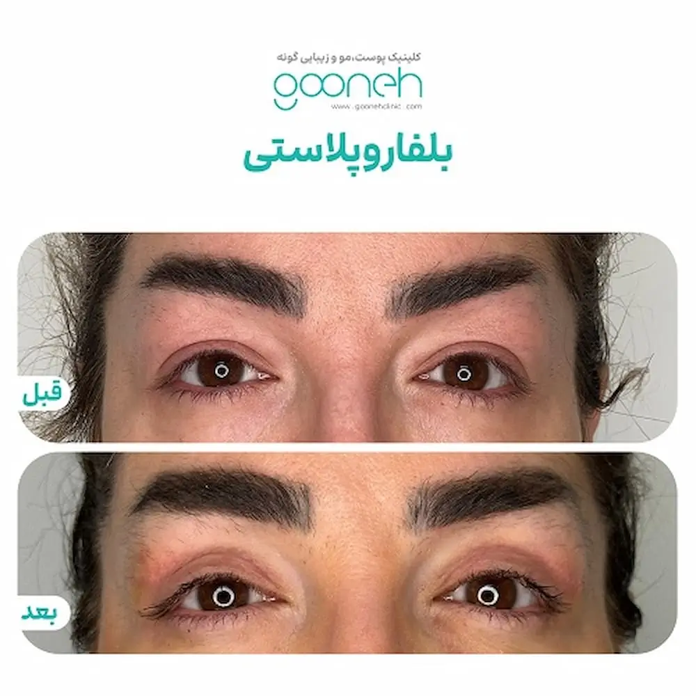 نمونه کار بلفاروپلاستی