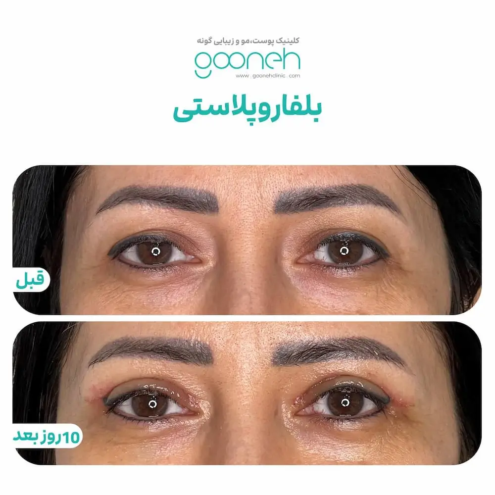 نمونه کار بلفاروپلاستی