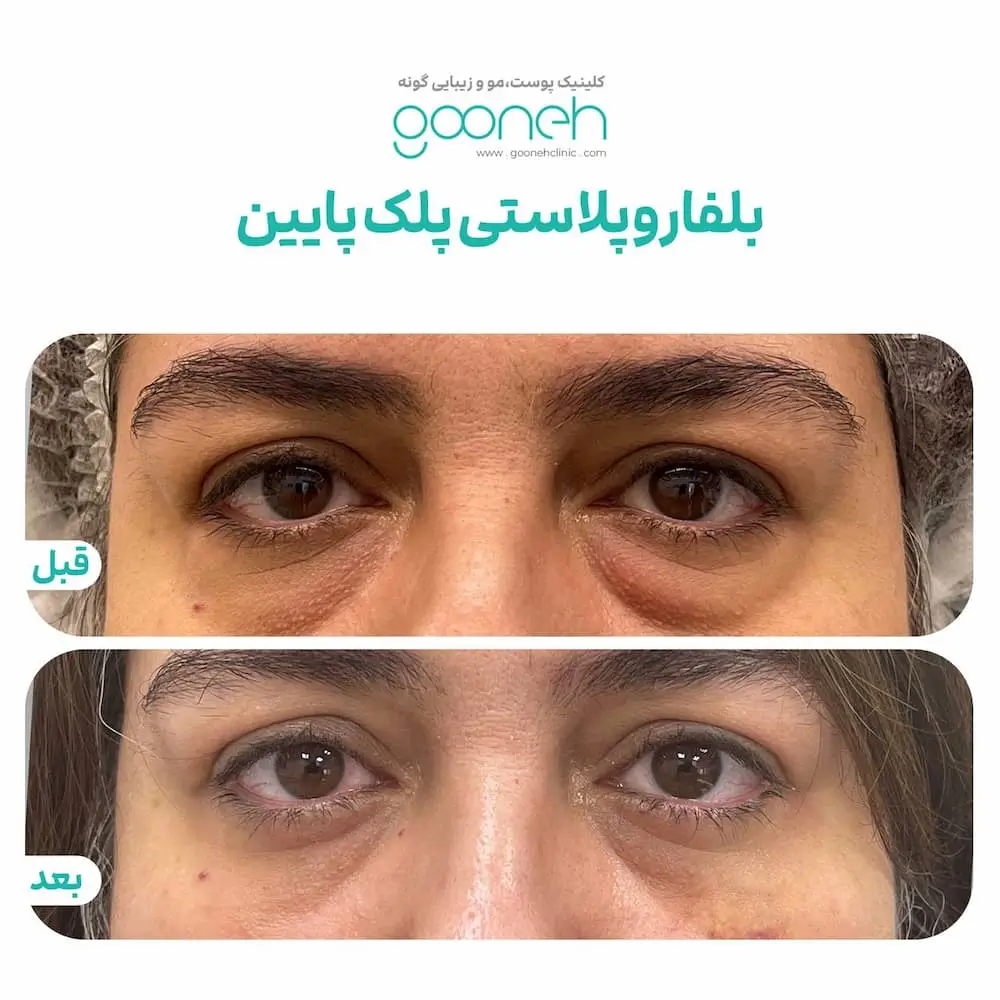 نمونه کار بلفاروپلاستی