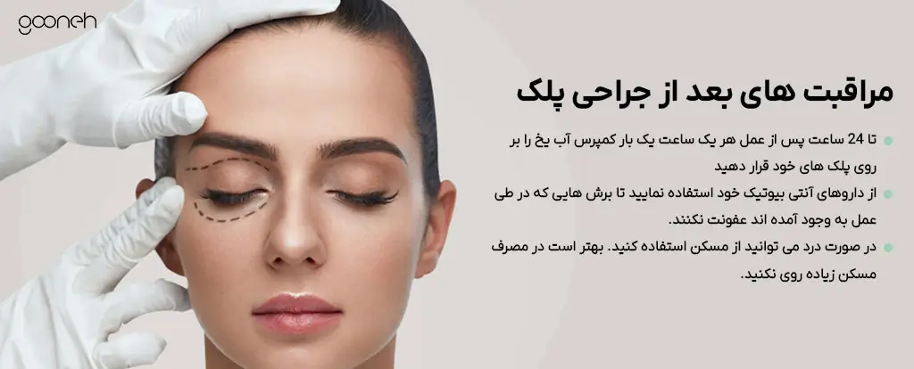 belpharo 5 min مراقبت های بعد از جراحی پلک (بلفاروپلاستی )