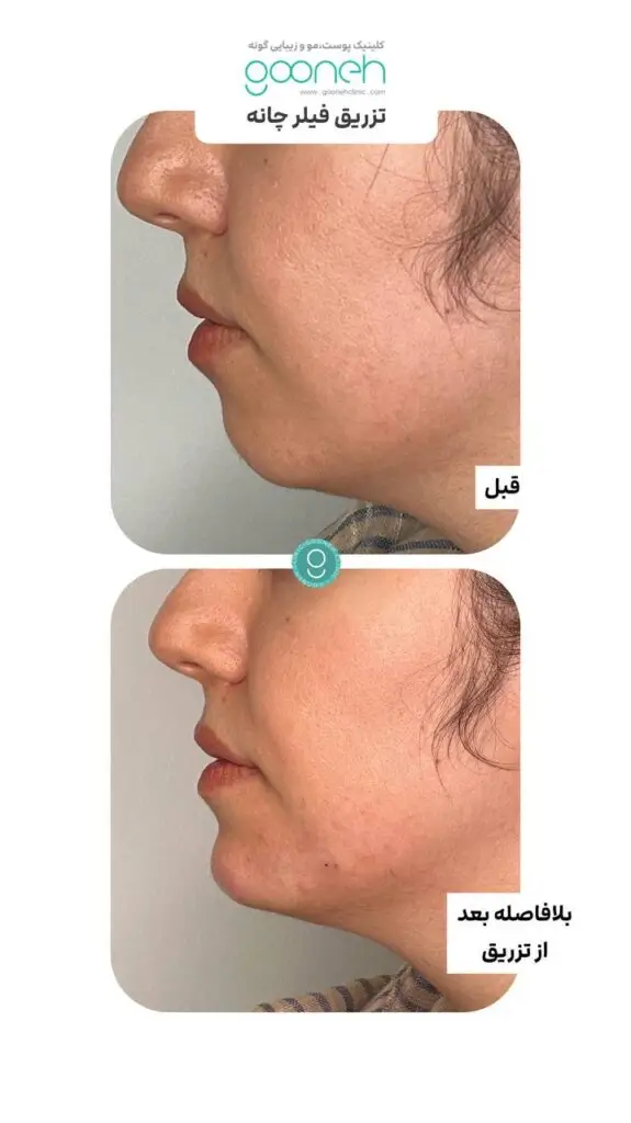 تزریق فیلر چانه