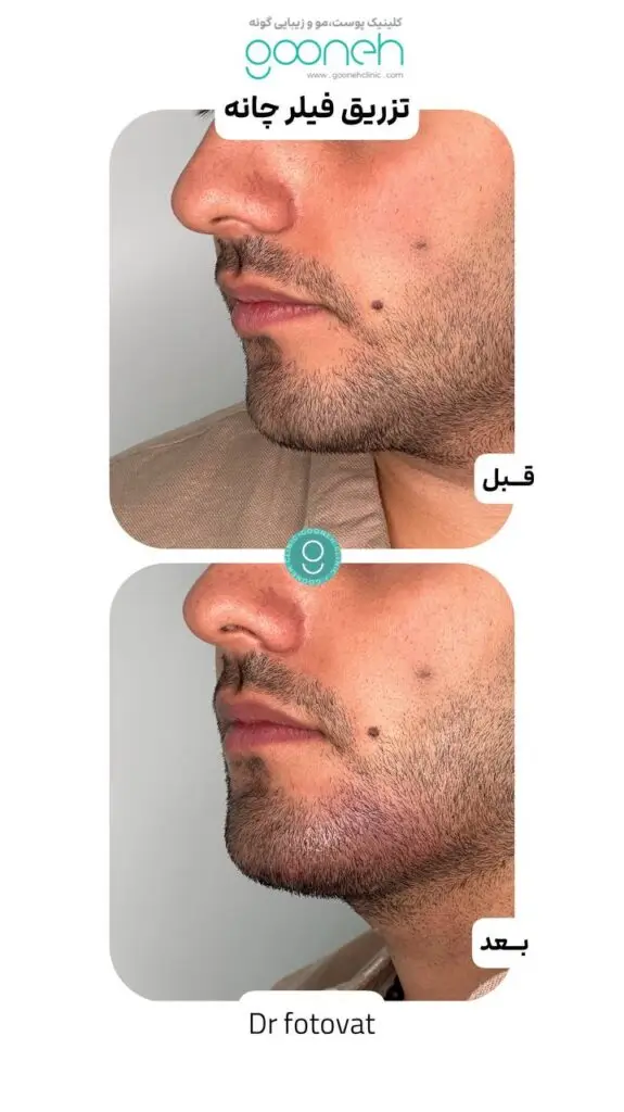 ماندگاری فیلر چانه