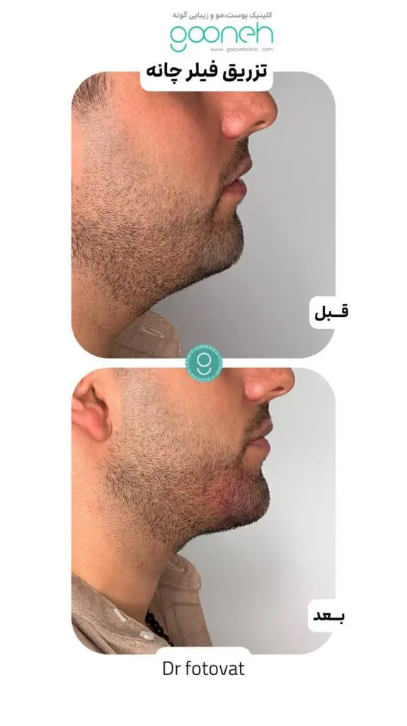 فیلر چانه