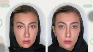تزریق فیلر زیر چشم