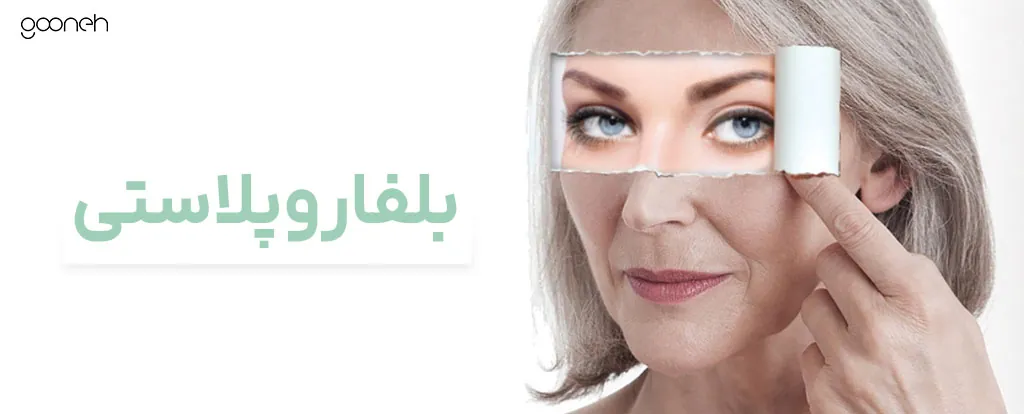 بلفاروپلاستی
