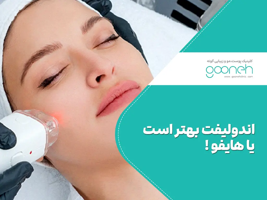اندوليفت بهتر است يا هايفو