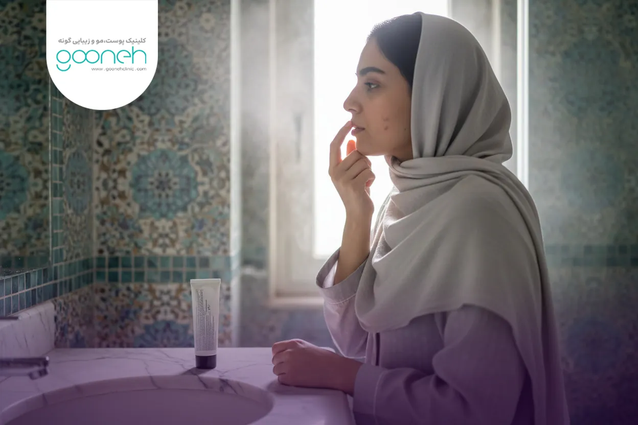 Ointment to remove brown spots left by acne پماد از بین بردن لکه های قهوه ای جای جوش