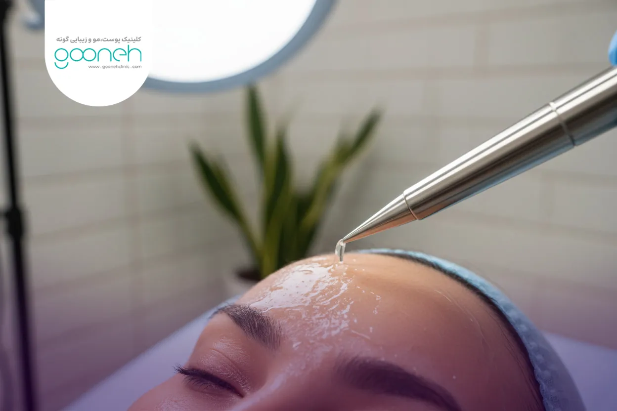 انواع لیزر برای چاله جای جوش