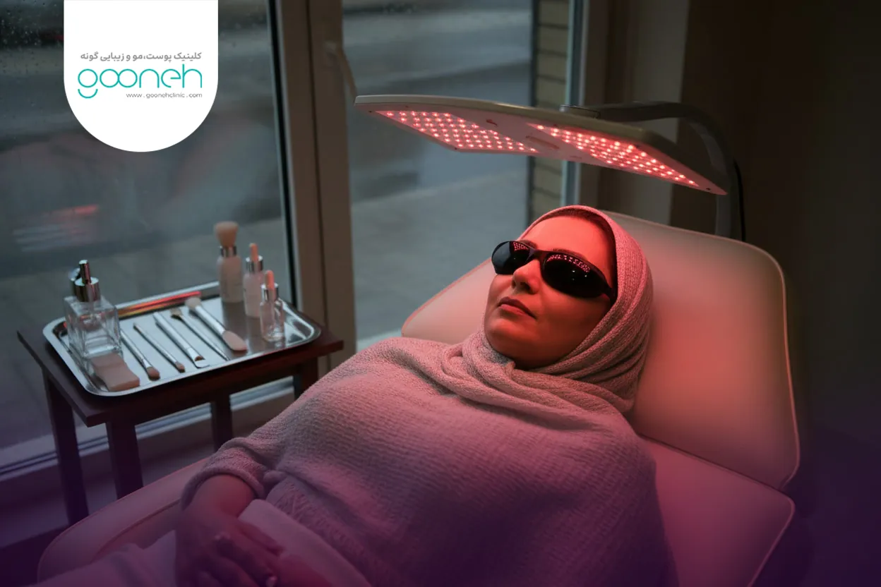 The latest method for removing acne scars 3 جدیدترین روش های درمان جای جوش